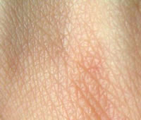 The Complete Guide to FTM Surgery Scar Care