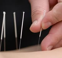 Acupuncture for Scar Healing